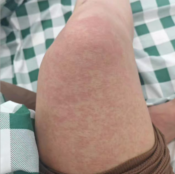股票配资持仓 佛山累计报告基孔肯雅热超3600例，患者口述：最难受的是......